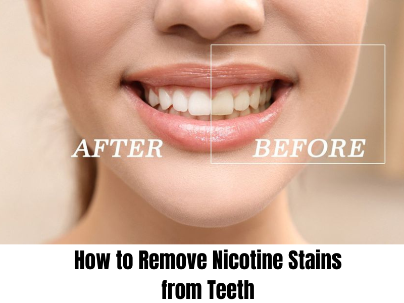 How to Remove Smoking Stains from Teeth | Expert Tips